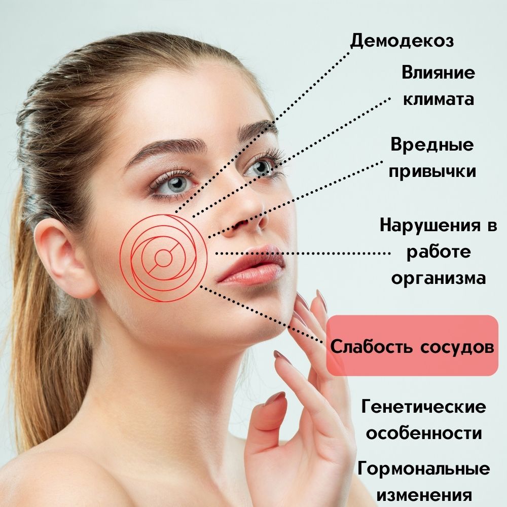 купероз на лице