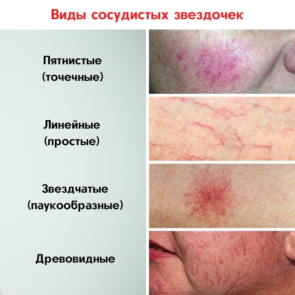 купероз на лице