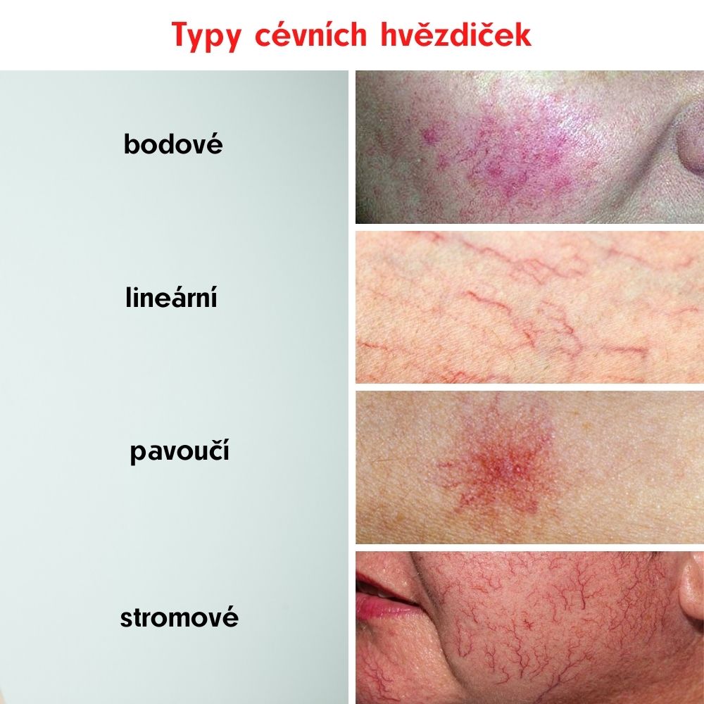 Couperose on the face