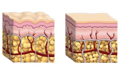 Cellulite removal