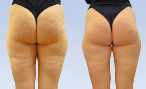 Cellulite
