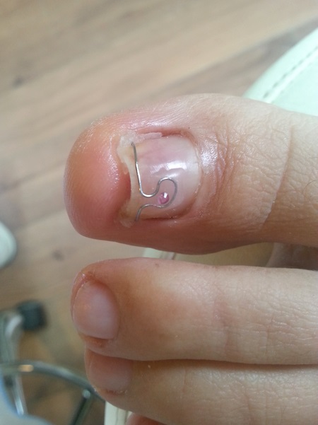 Ingrown toenail treatment with nail braces