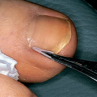 Ingrown toenail treatment – sulci protector