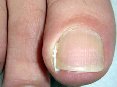 Ingrown toenail treatment – tamponade