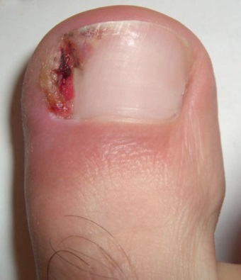 Ingrown toenail photo